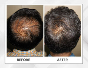 Hair Loss Treatment in Kolkata | Male Hair Loss Treatment India