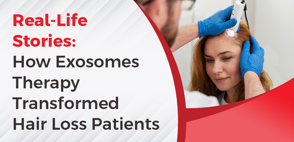 Real-Life Stories: How Exosomes Therapy Transformed Hair Loss Patients