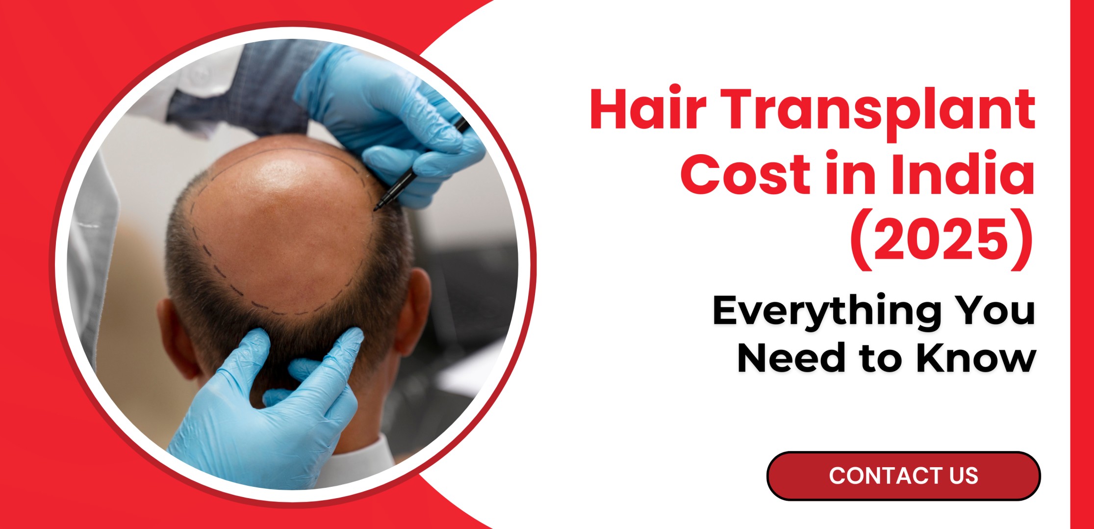 Hair Transplant Cost in India (2025) – Everything You Need to Know