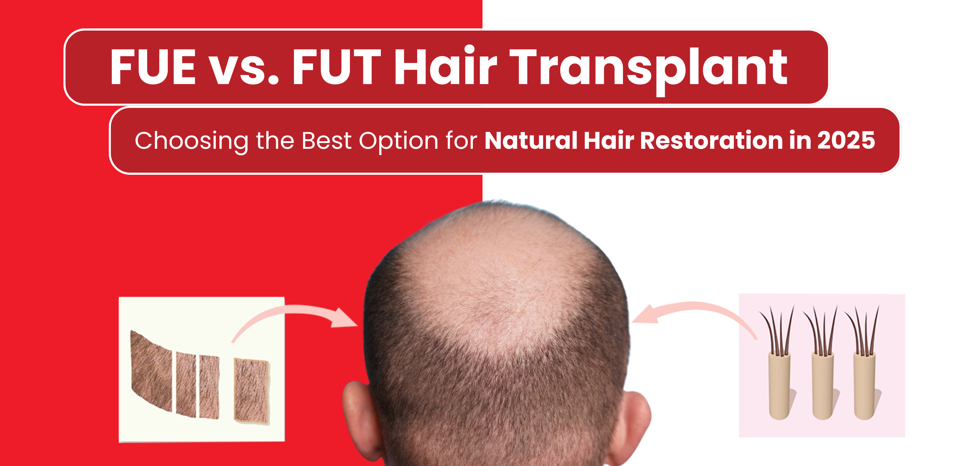 FUE vs. FUT Hair Transplant – Choosing the Best Option for Natural Hair Restoration in 2025