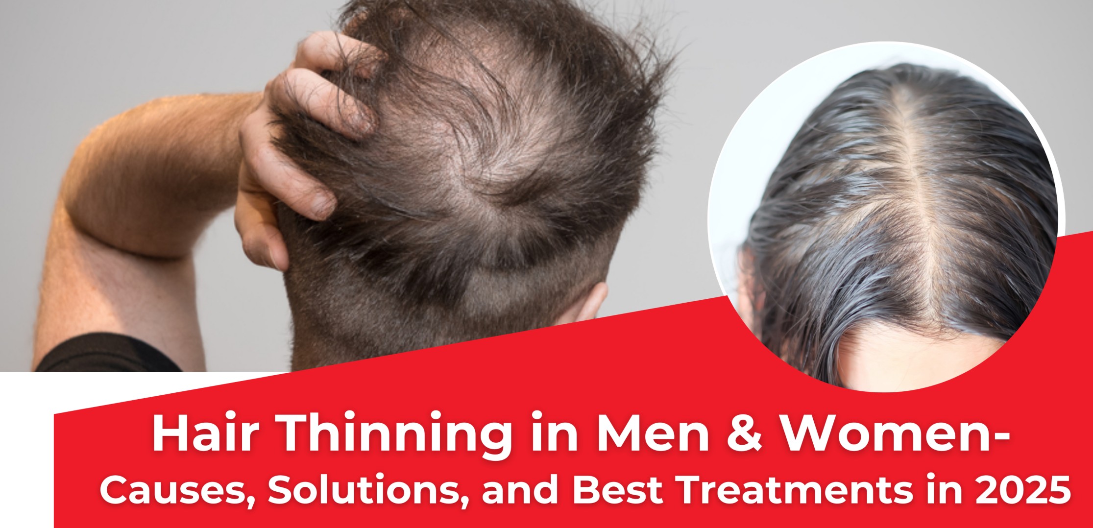 Hair Thinning in Men & Women – Causes, Solutions, and Best Treatments in 2025