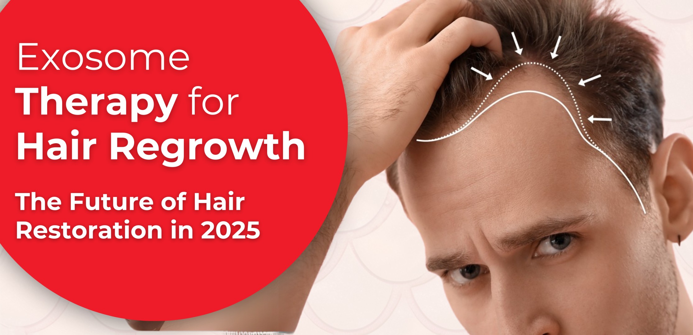 Exosome Therapy for Hair Regrowth – The Future of Hair Restoration in 2025